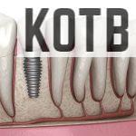 implantes dentales