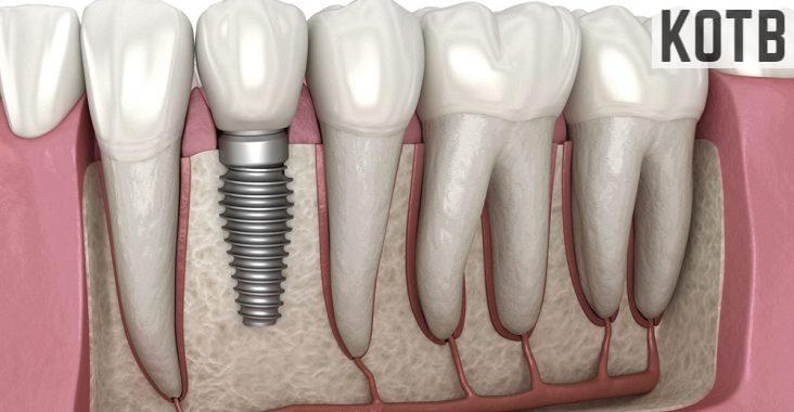 implantes dentales